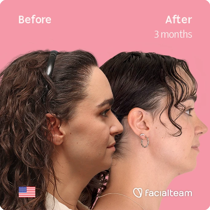 Side-by-side profile photos showing a before-and-after comparison: left labeled 'Before', right labeled 'After 3 months', with improved jawline on the right. Pink background and Facialteam logo.