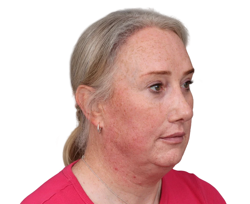 Portrait of a middle‑aged woman with fair skin and rosacea, facing slightly to the right, wearing a pink top and small hoop earring.