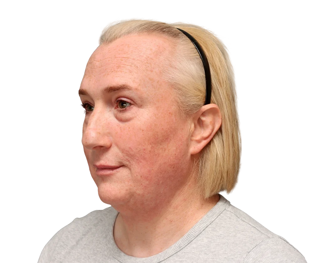 Side-profile portrait of a woman with light blonde hair wearing a black headband; visible facial redness and freckles.