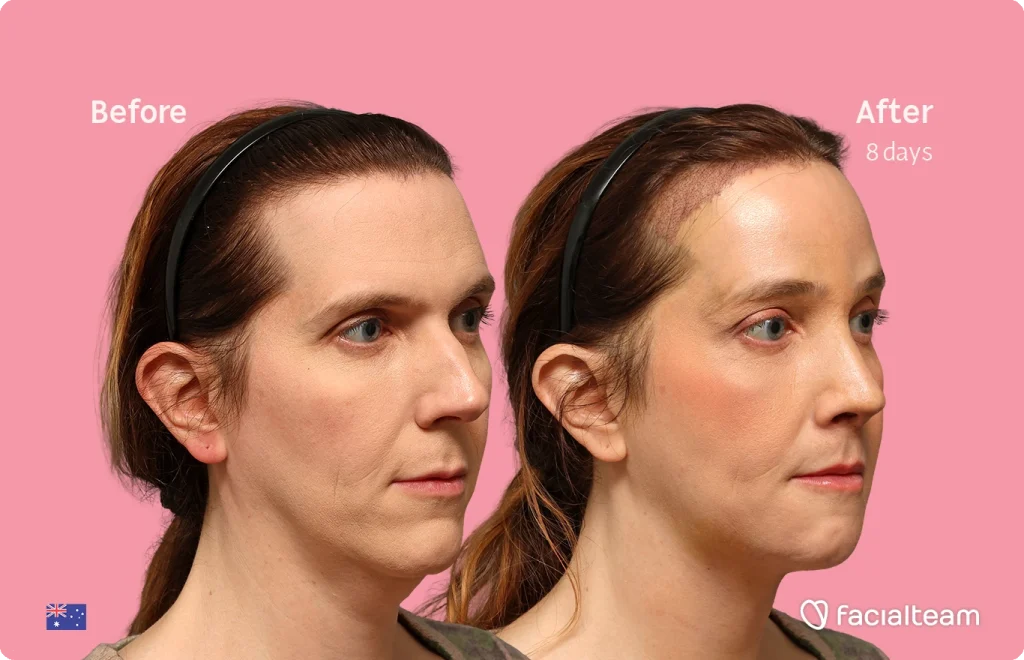 Side-by-side before-and-after photos of a woman on a pink background; left labeled Before, right labeled After 8 days, with Facialteam logo bottom right.
