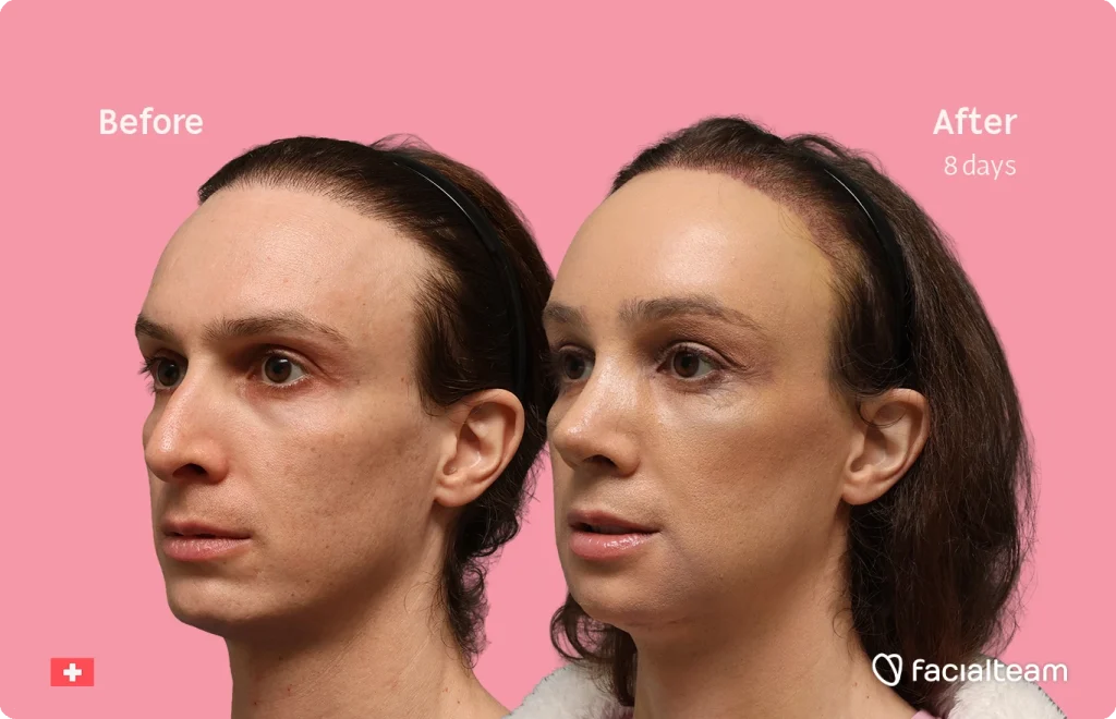 Side-by-side portraits of a woman: left shows pre-treatment skin, right after 8 days of treatment; pink backdrop.