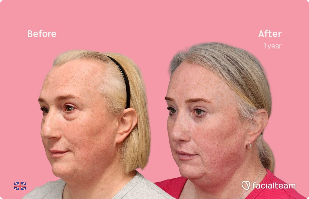 Side-by-side photo showing a woman's face before (left) and after (right) one year of treatment, with smoother skin and reduced redness.
