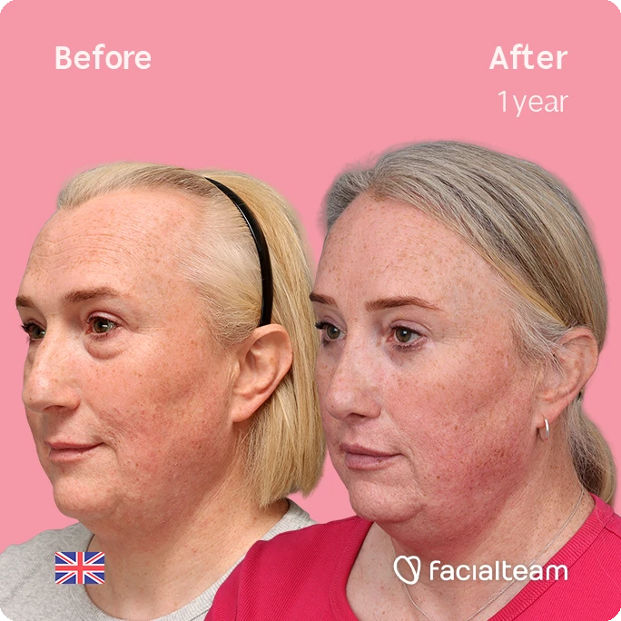 Side-by-side photo: a woman's face before (left) and after one year of facial treatment, showing clearer skin and less redness.