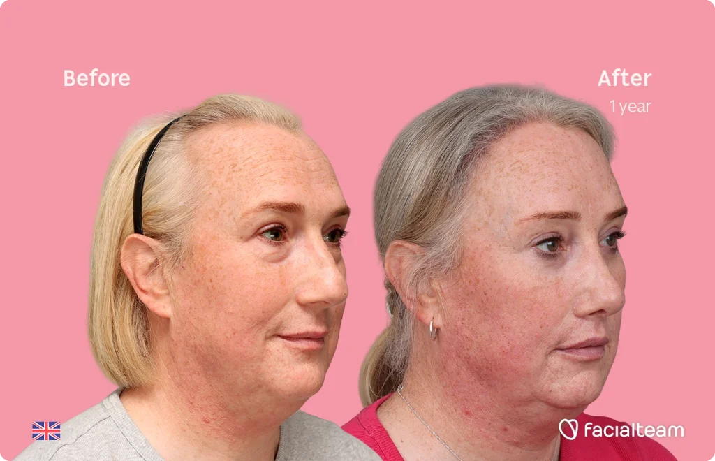 Side-by-side comparison showing a woman's face before and after a cosmetic treatment with a pink background; 'Before' on left, 'After 1 year' on right.