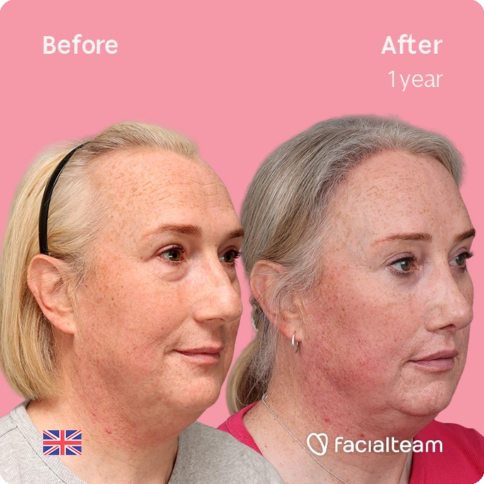Side-by-side photo: left shows a woman before treatment, right shows after one year with smoother skin and less fullness around the jaw.