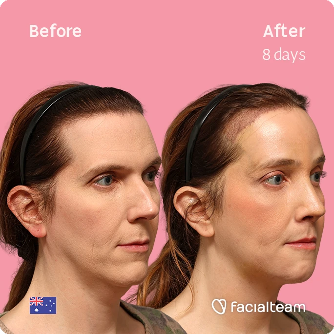 Before and after portrait of a woman showing cosmetic treatment results: left labeled 'Before', right labeled 'After 8 days', with smoother skin and subtle jawline improvement against a pink background; Facialteam logo appears bottom right.
