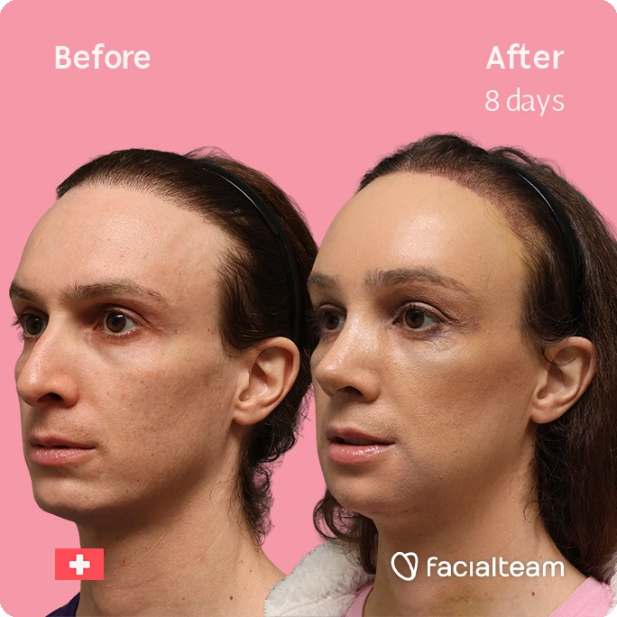 Before-and-after photo showing a woman’s face: left is before with uneven skin, right is after 8 days with smoother jawline and fuller cheeks on a pink background; Faciaalteam logo visible.