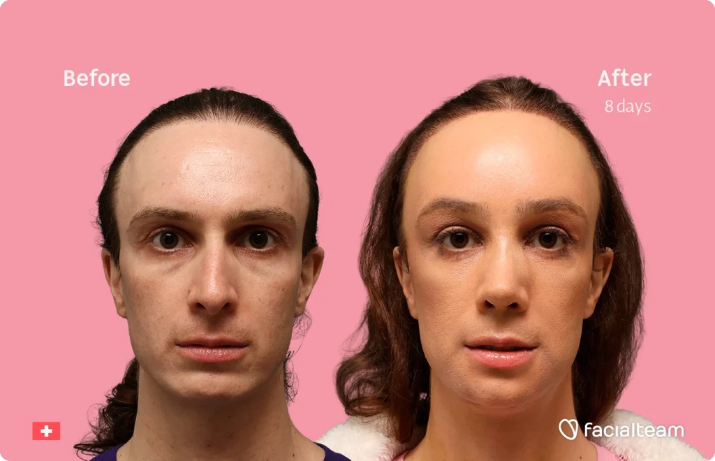 Before and after facial treatment: left shows untreated face; right shows improved skin after 8 days, pink background with branding.