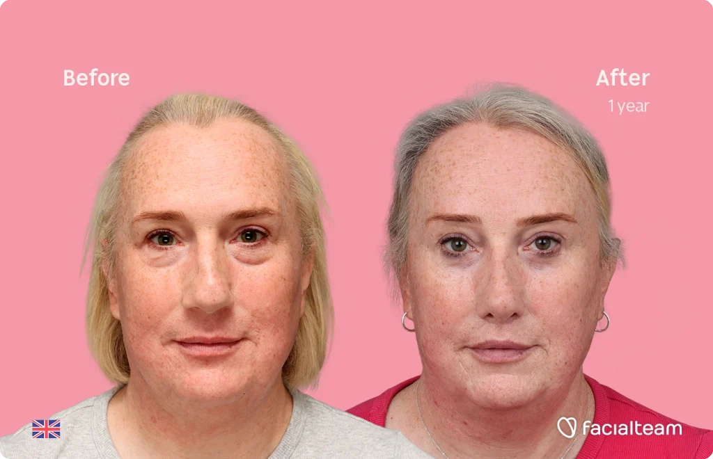 Side-by-side headshots of a woman with freckles: Before on the left and After 1 year on the right, on a pink background, showing clearer skin.
