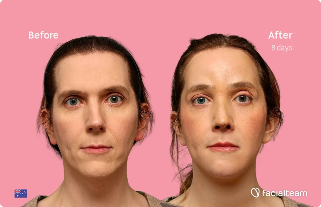 Before and after side-by-side portrait showing facial improvement after 8 days of treatment on pink background; branding in corner.