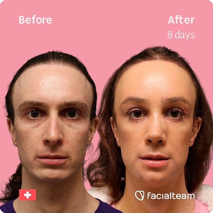 Before and after photos of a woman's face: left image before treatment, right image after 8 days, showing smoother skin and improved complexion.