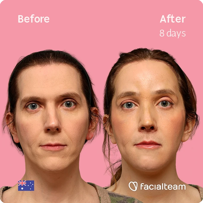 Side-by-side portrait showing a woman before and eight days after treatment on a pink background: 'Before' on the left with a neutral complexion, 'After 8 days' on the right with smoother skin; bottom-right shows the Facialteam logo.