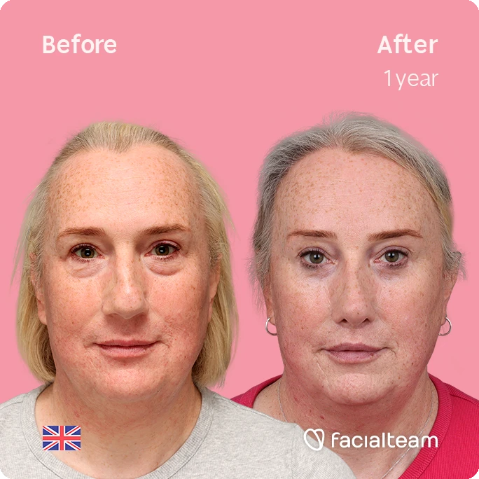 Side-by-side portrait of a woman: left labeled 'Before', right labeled 'After 1 year' showing improved skin tone on pink background.