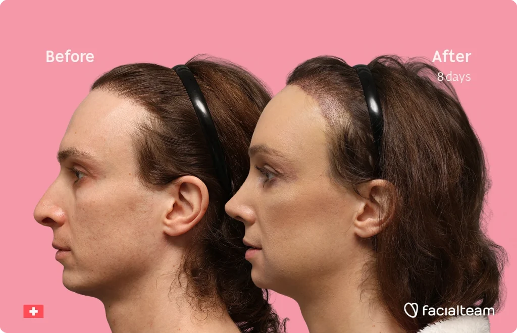 Side-by-side profile photos labeled Before and After (8 days) showing facial improvement on a pink background, with FaciaTeam branding bottom right and a small Swiss flag bottom left.