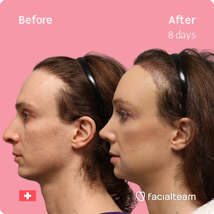 Before (left) and After 8 days (right) side‑profile photos of a woman's face showing improved facial contour after treatment; pink background, Facileteam logo visible.
