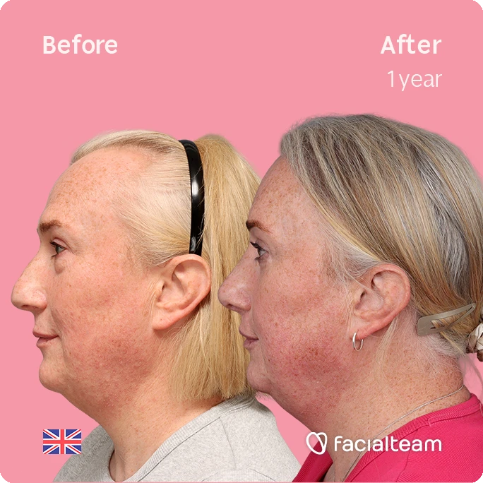 Side-by-side profile photos showing before and after 1 year of treatment, with noticeable skin improvement on the after image, set against a pink background.