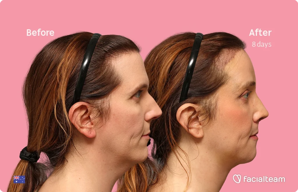 Side-by-side profile photos of a woman before and eight days after treatment, pink background, headset bands visible, Facialteam branding in corner.