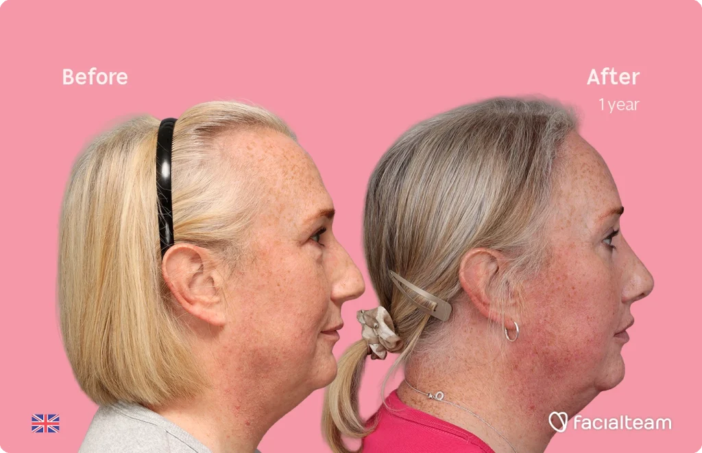 Side-by-side profile of a woman labeled Before and After (1 year) against a pink background, highlighting facial transformation.