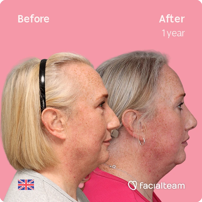 Side-by-side profile of a woman before and after facial treatment after one year, showing a tighter jawline and smoother neck against a pink background (with 'Before' and 'After 1 year' labels).