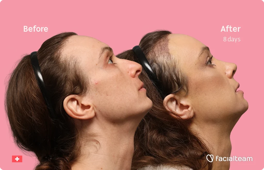 Side-by-side profile of a woman labeled 'Before' and 'After 8 days' against a pink background, showcasing treated facial skin; Facialteam logo visible