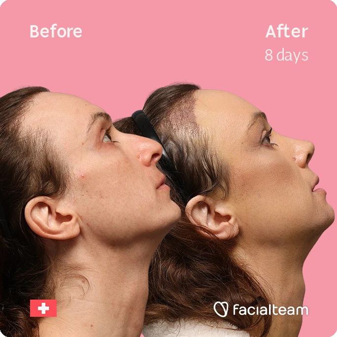 Side-by-side profile of a woman's face before (left) and after 8 days of treatment, showing a more defined jawline and smoother skin; pink background with 'Before' and 'After 8 days' labels and facialteam logo.