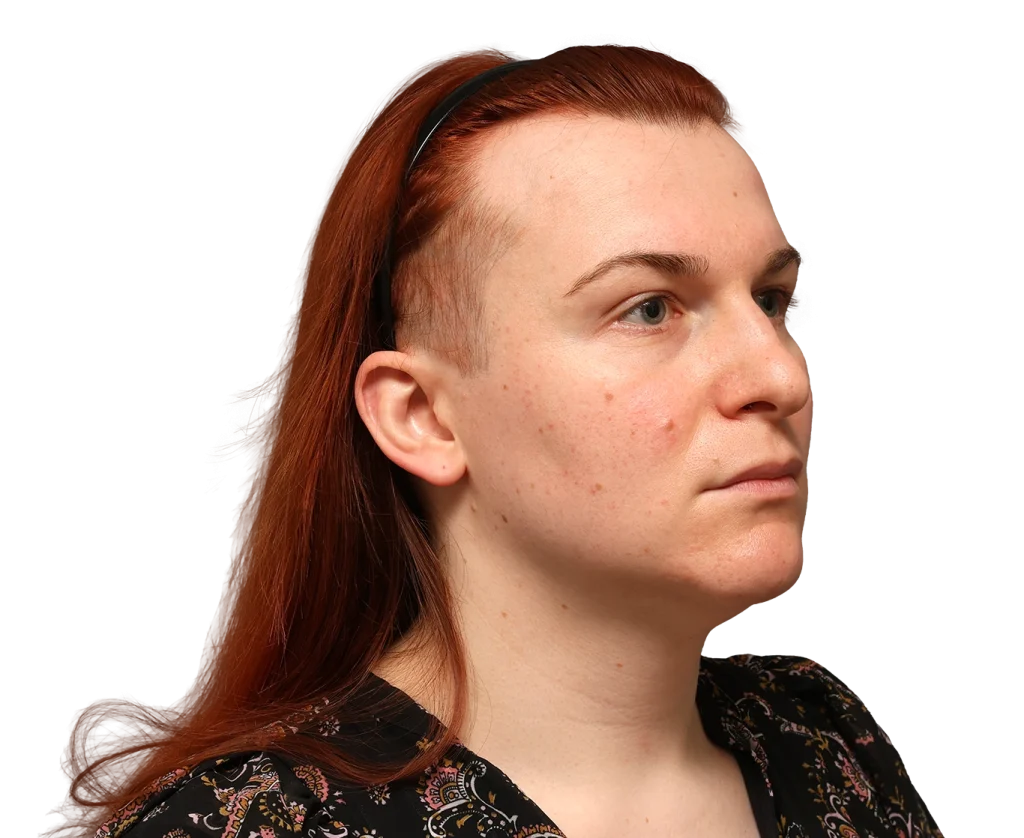 Profile of a woman with red hair and a black headband, showing skin with some acne on the cheek and jawline.