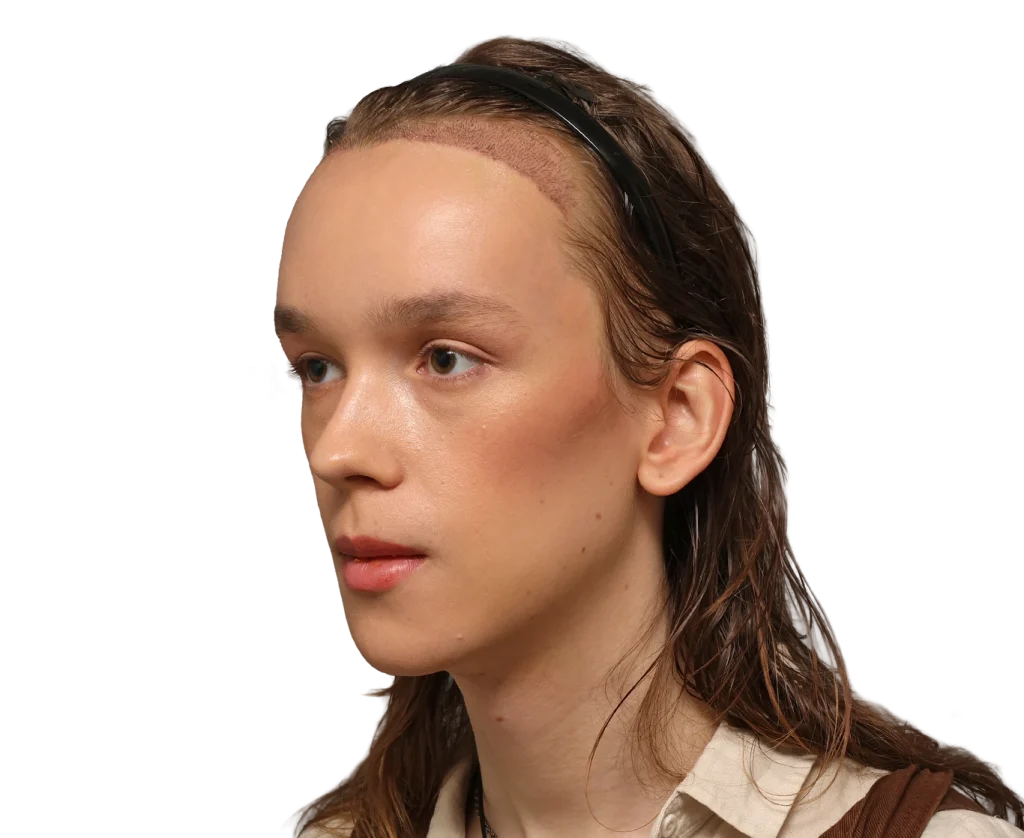 Profile view of a young woman with a visible hairline scar along the forehead, wearing a black headband.