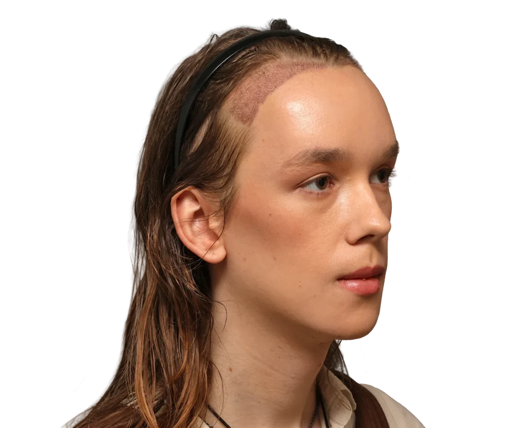 Side profile of a young woman with a shaved, patchy area along the hairline near the temple showing a scalp treatment or patch area.