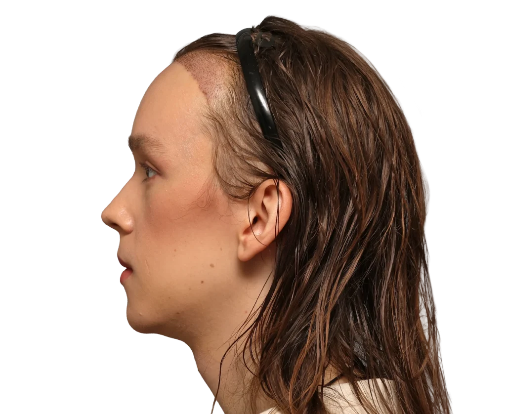 Profile of a woman facing left with a large scar along the left temple and forehead, wearing a black headband and wet hair.