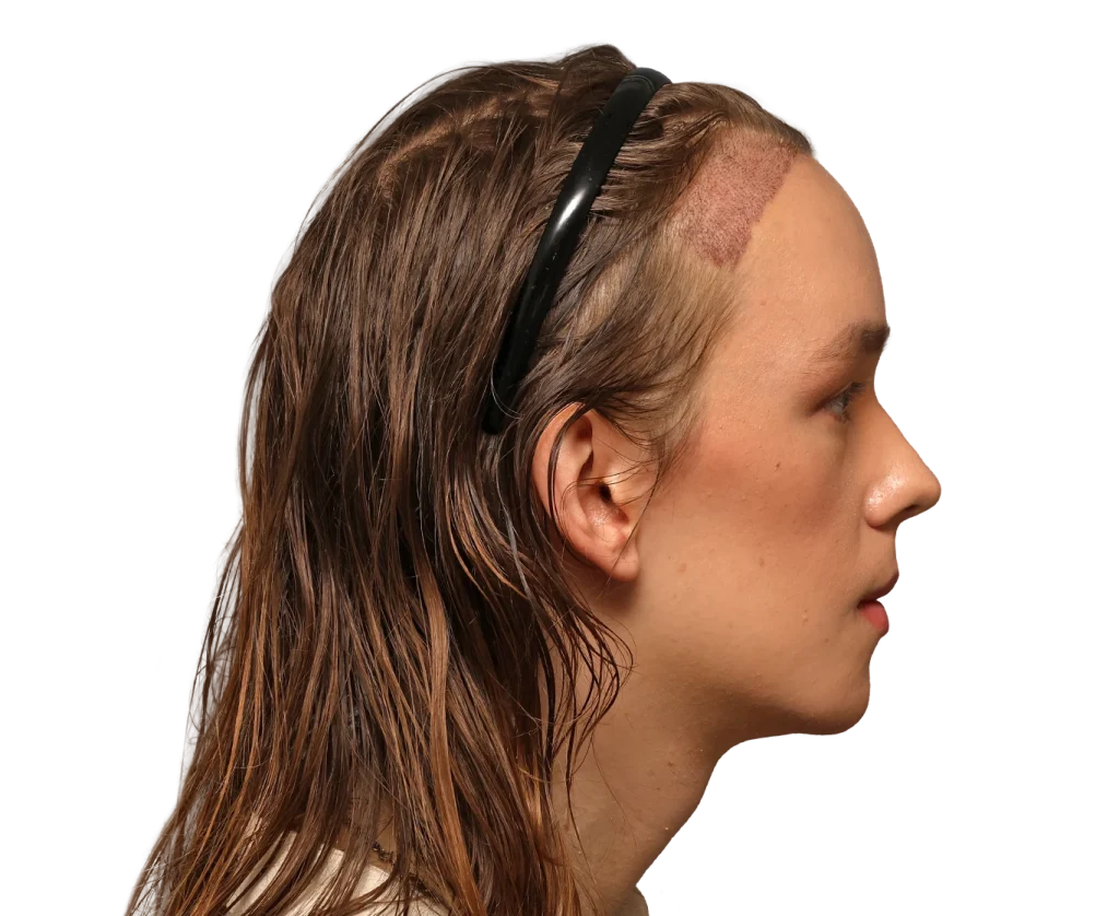 Side profile of a woman with shoulder-length wet hair and a black headband, showing a large scar along the temple/side of the scalp near the hairline.