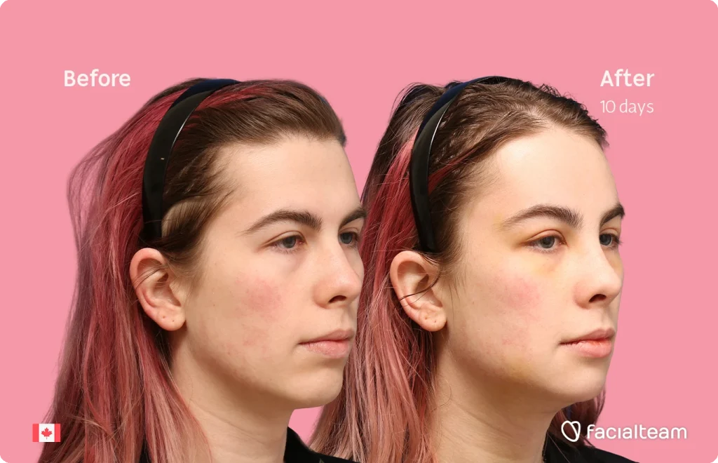 Before and after comparison of a woman's face showing skin improvement after treatment; pink background, 'Before' on left and 'After 10 days' on right.