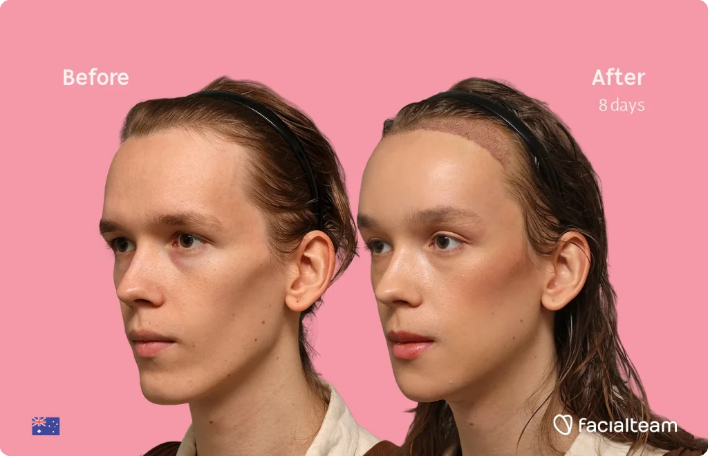Side-by-side photos showing a woman's face before and eight days after a facial procedure, against a pink background.
