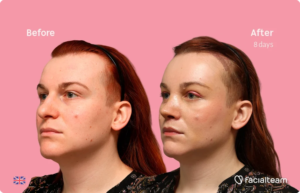 Side-by-side image of a woman’s face before (left) and after eight days of treatment, pink background.