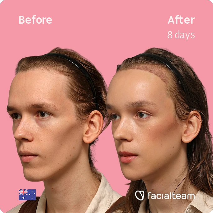 Side-by-side portrait of a young woman—left labeled 'Before' and right labeled 'After 8 days' with a pink background; after shows a healed scar along the hairline along with smoother skin.