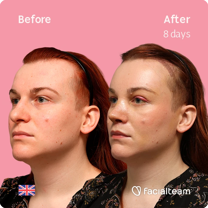 Side-by-side portraits of a woman before and after 8 days of treatment, showing reduced redness and improved skin texture.
