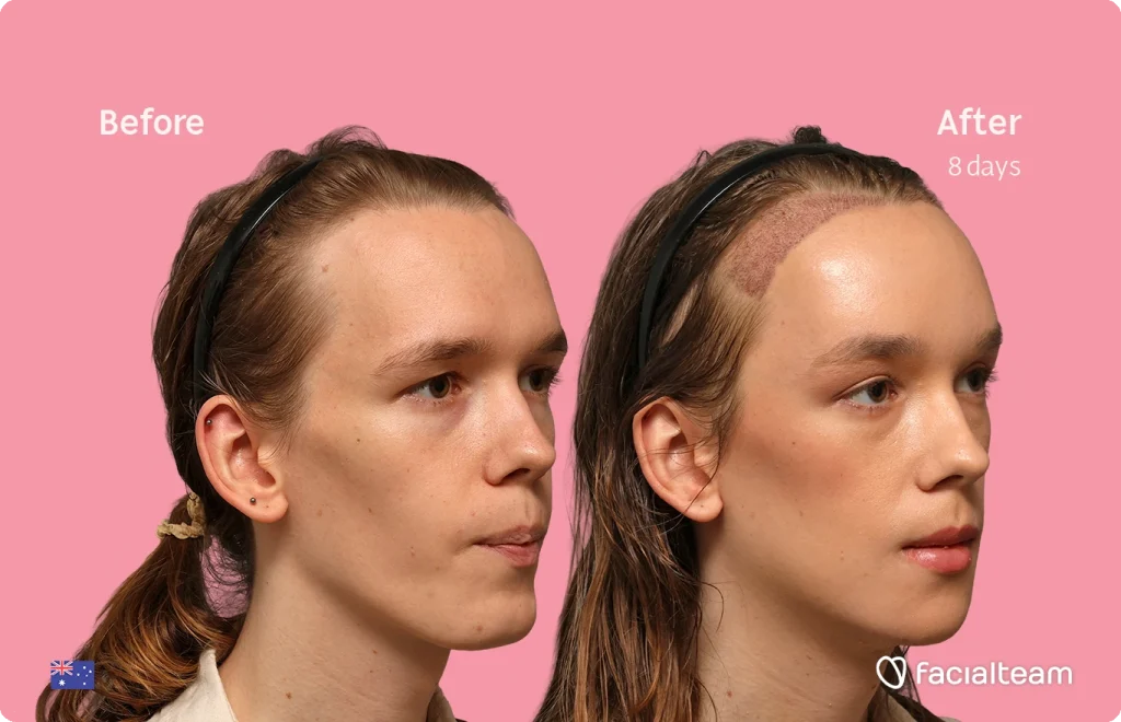 Side-by-side portrait of a woman: left 'Before', right 'After 8 days' post-scalp treatment; pink background.