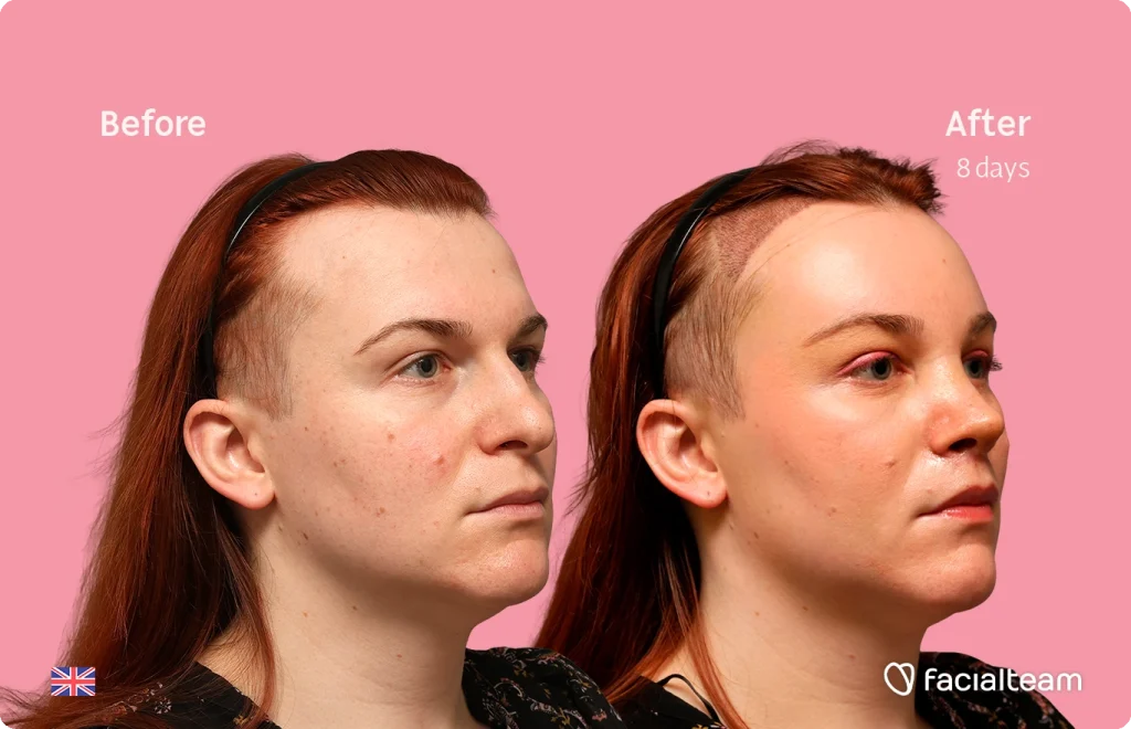 Before and after portrait of a woman with shaved side showing skin improvement after 8 days, pink background, FacialTeam logo visible.