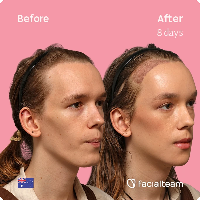 Side-by-side portraits on a pink background: left 'Before', right 'After 8 days', showing smoother skin and improved facial contour after treatment; facialteam logo.