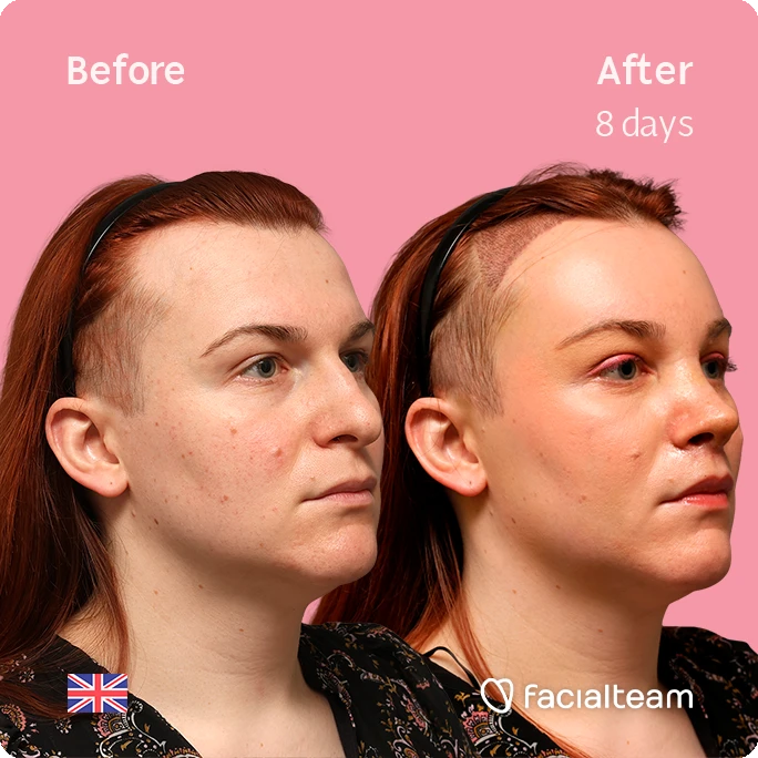 Comparison photo showing a woman's face before and eight days after treatment, on a pink background with 'Before' and 'After 8 days' text; includes small UK flag and Facialteam logo.