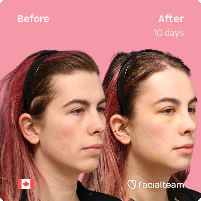 Side-by-side profile photos showing facial skin improvement after 10 days of treatment; left labeled Before, right labeled After, pink background, headbands worn.