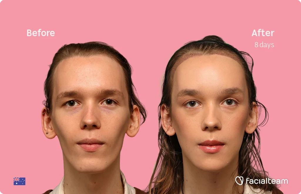 Side-by-side portrait comparison of a woman before (left) and after 8 days of treatment, on a pink background; facialteam branding.