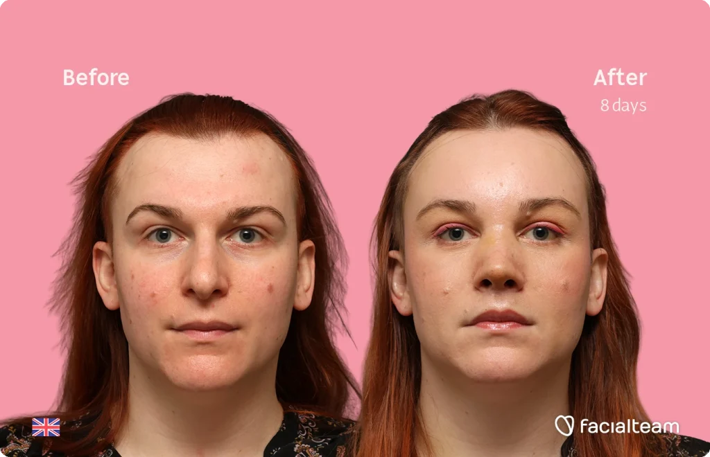 Side-by-side portrait: a woman with red hair on a pink background showing 'Before' (left) and 'After 8 days' (right) with improved skin clarity; logo bottom right.