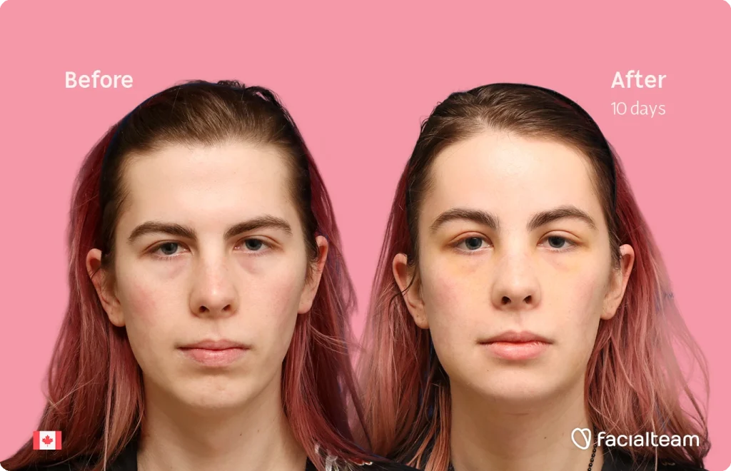 Before-and-after portrait: woman's face on pink background, left labeled 'Before', right labeled 'After 10 days' (facial treatment)