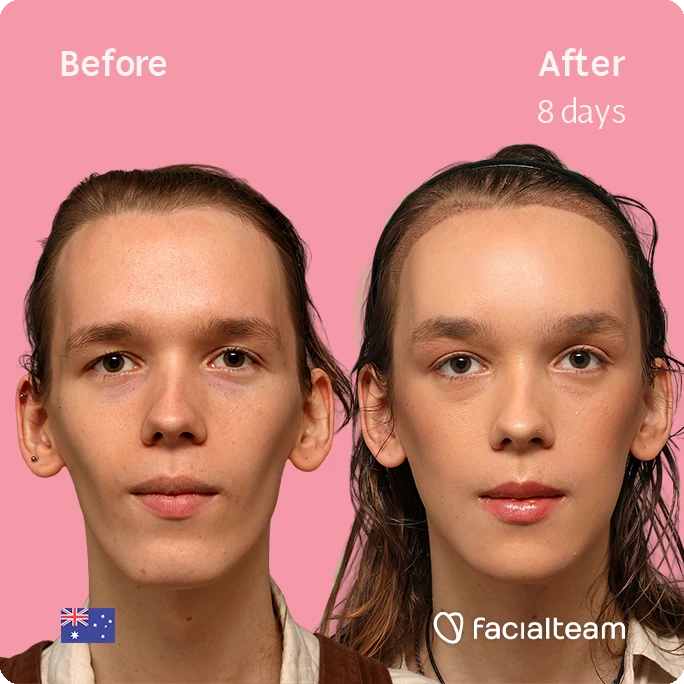 Before and after portraits of a woman showing facial treatment results on a pink background; left labeled 'Before', right labeled 'After 8 days'; Australian flag and Facailteam logo visible