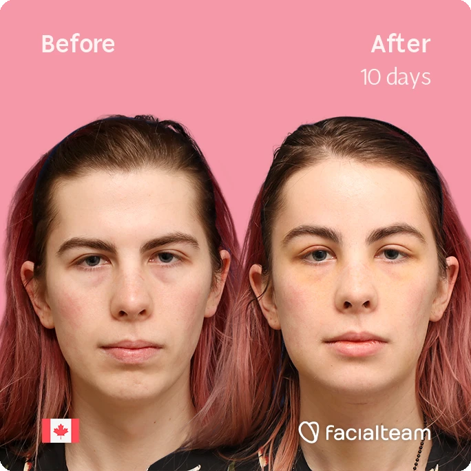 Before and after comparison of a woman's face over 10 days on a pink background; left image is before, right image is after (10 days); Canadian flag icon bottom left and Facailteam watermark bottom right.