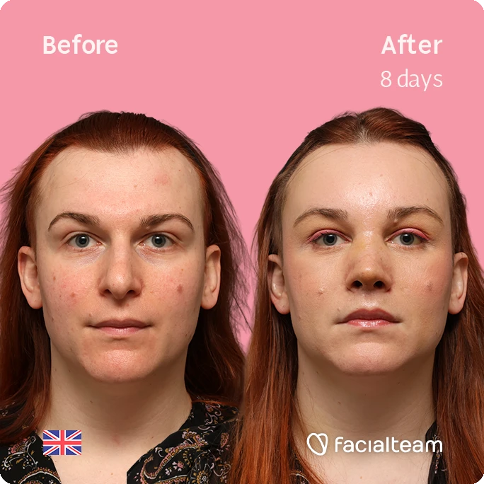 Side-by-side photos: left labeled 'Before', right after 8 days with clearer skin; pink background, UK flag bottom-left, Facialteam logo bottom-right.