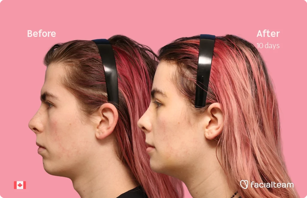 Side-by-side profile of a pink-haired woman wearing headphones, showing 'Before' on the left and 'After 10 days' on the right against a pink background, for a treatment comparison.