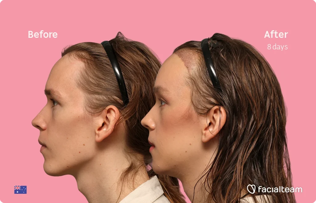 Side-by-side profile photos of a woman before and eight days after a facial treatment, shown against a pink background with 'Before' and 'After 8 days' labels, by Facialteam.