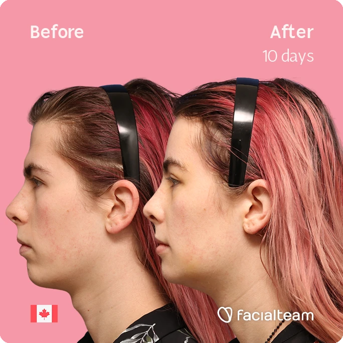 Side-by-side profile: left shows before, right shows after 10 days, woman with pink hair and headband against pink background; Canada flag bottom left, Facetialteam logo bottom right.