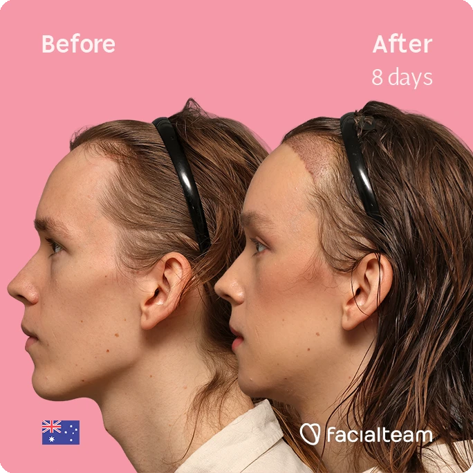 Side-by-side profile of a woman showing before and after results eight days after treatment, pink background, headband still on (facialteam branding).